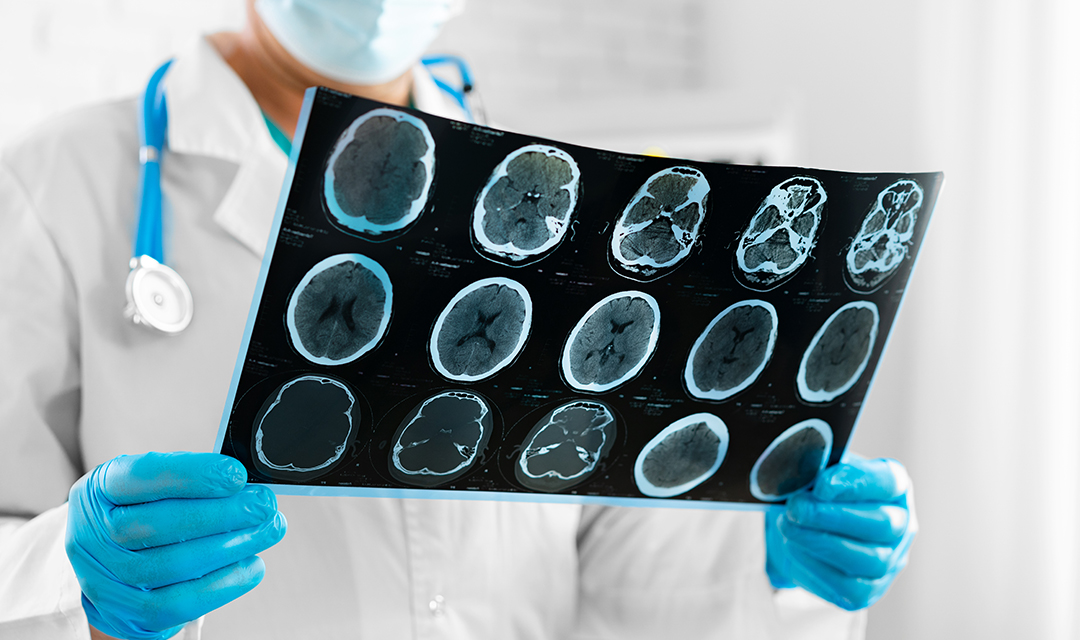5 Warning Signs You Might Have a Brain Tumor